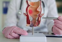 prevenir-transformation-cancereuse-polype