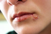 herpes-buccal-symptomes