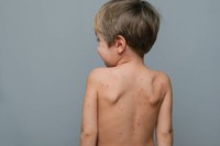 combien-de-temps-durent-boutons-varicelle