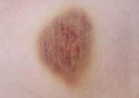 comment-savoir-si-un-hematome-est-grave