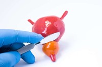 prostatectomie-cest-quoi
