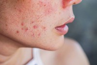 comment-reconnaitre-acne-hormonale