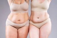 avantages-sleeve-gastroplastie