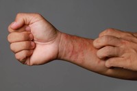 eczema-urticaire