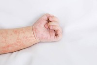 rubeole-igg-positif-chez-la-femme-enceinte