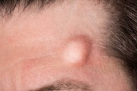 comment-enlever-une-boule-de-graisse-visage