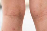 aliments-a-eviter-maladie-lichen-plan