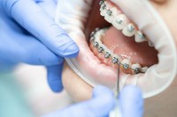 orthodontie-enfant-age