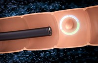 qu-est-ce-qu-un-polype