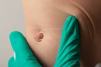 peut-on-vivre-avec-une-hernie-ombilicale