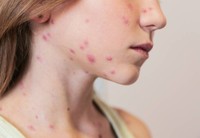 premiers-signes-varicelle