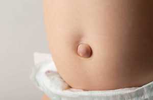 Hernie ombilicale : symptômes et opération