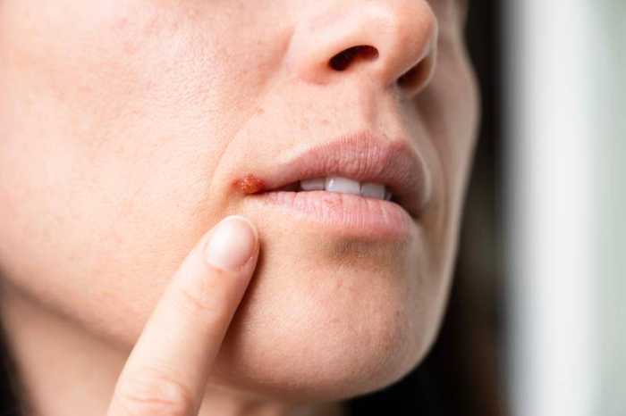 Herpès buccal : symptômes, causes, transmission et traitements
